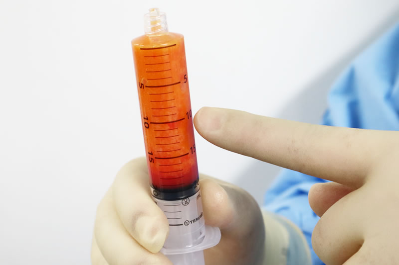 ピュアグラフトの脂肪